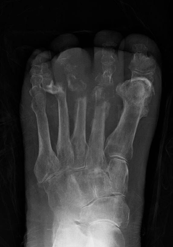 Osteomyelitis
