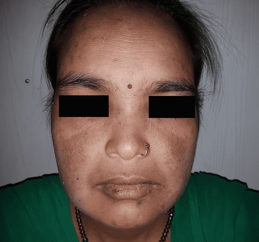 Malar rash