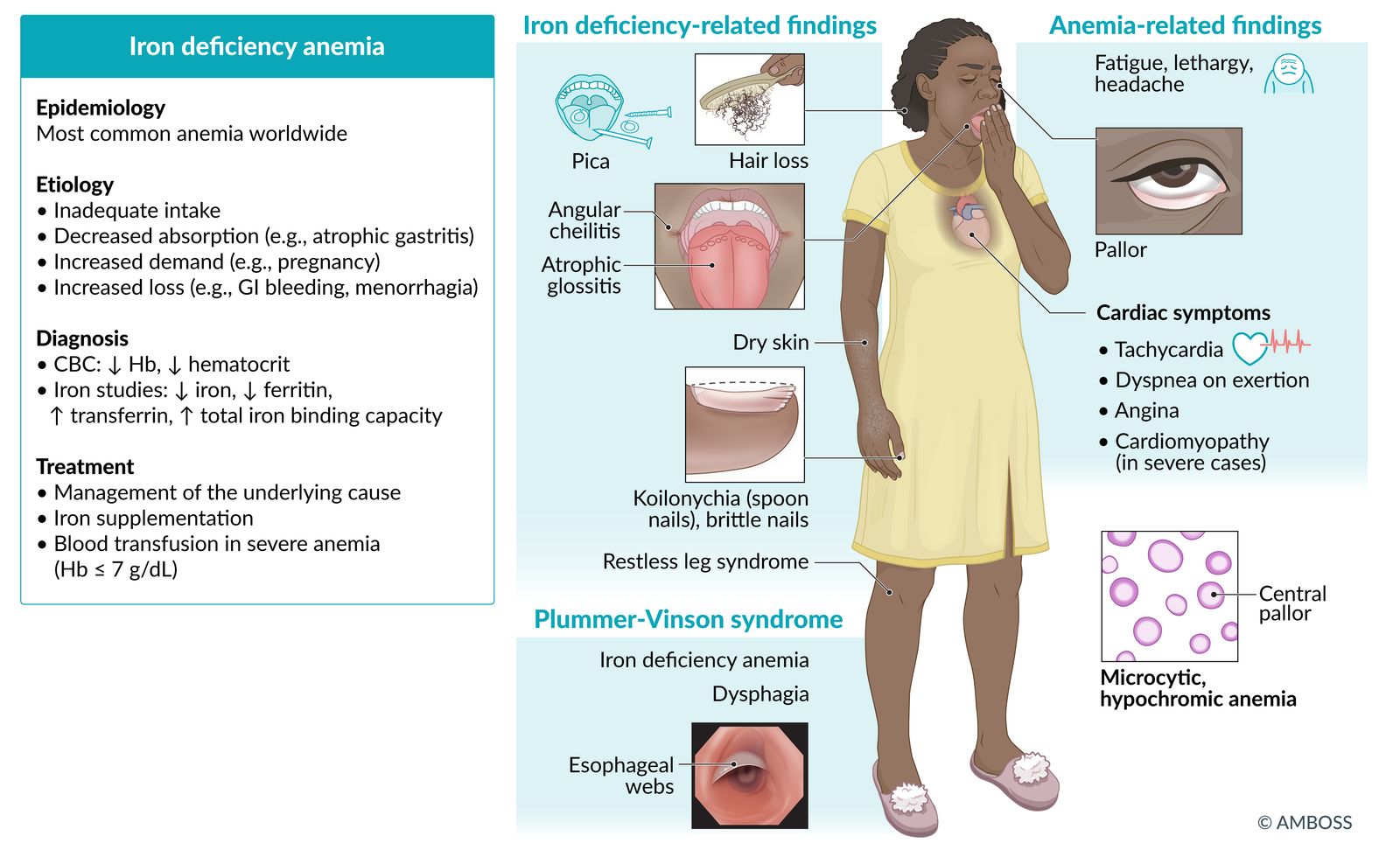 Iron deficiency anemia fact sheet