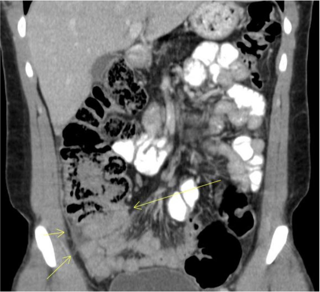 Distal intestinal obstruction syndrome (DIOS)
