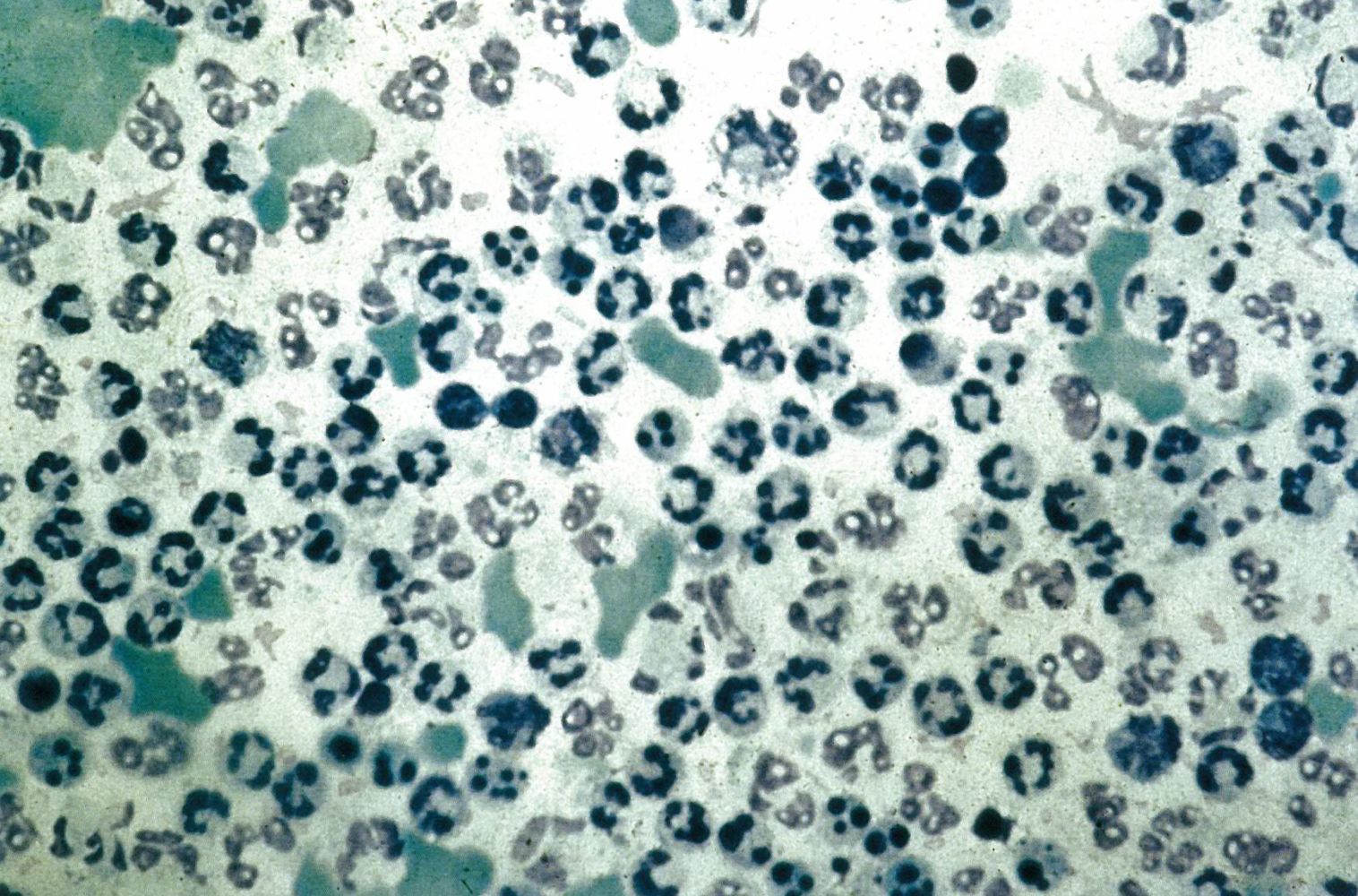 Synovial fluid in septic arthritis