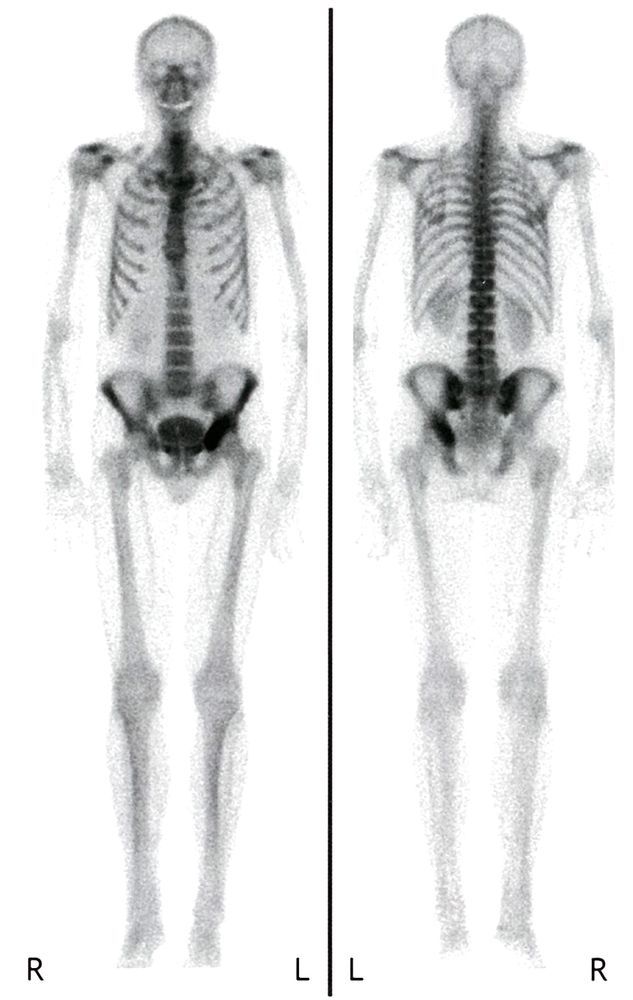 Pelvic tumor with increased uptake on bone scan