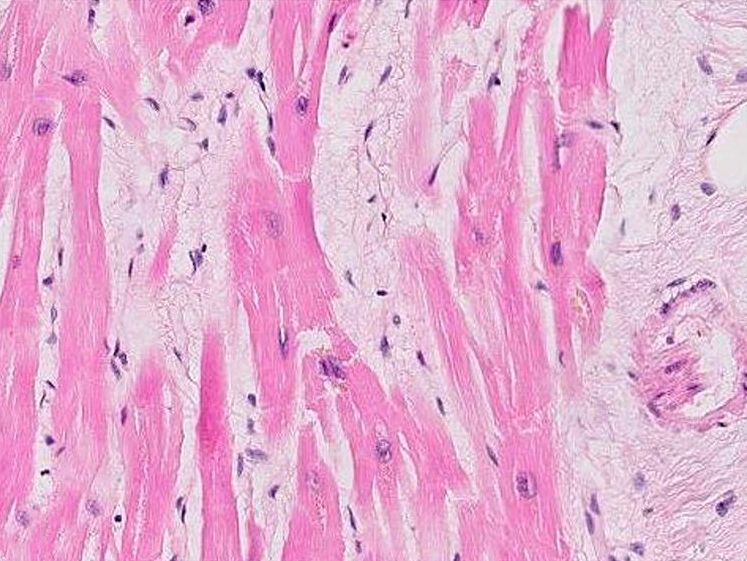 Myocardial infarction (coagulative necrosis)