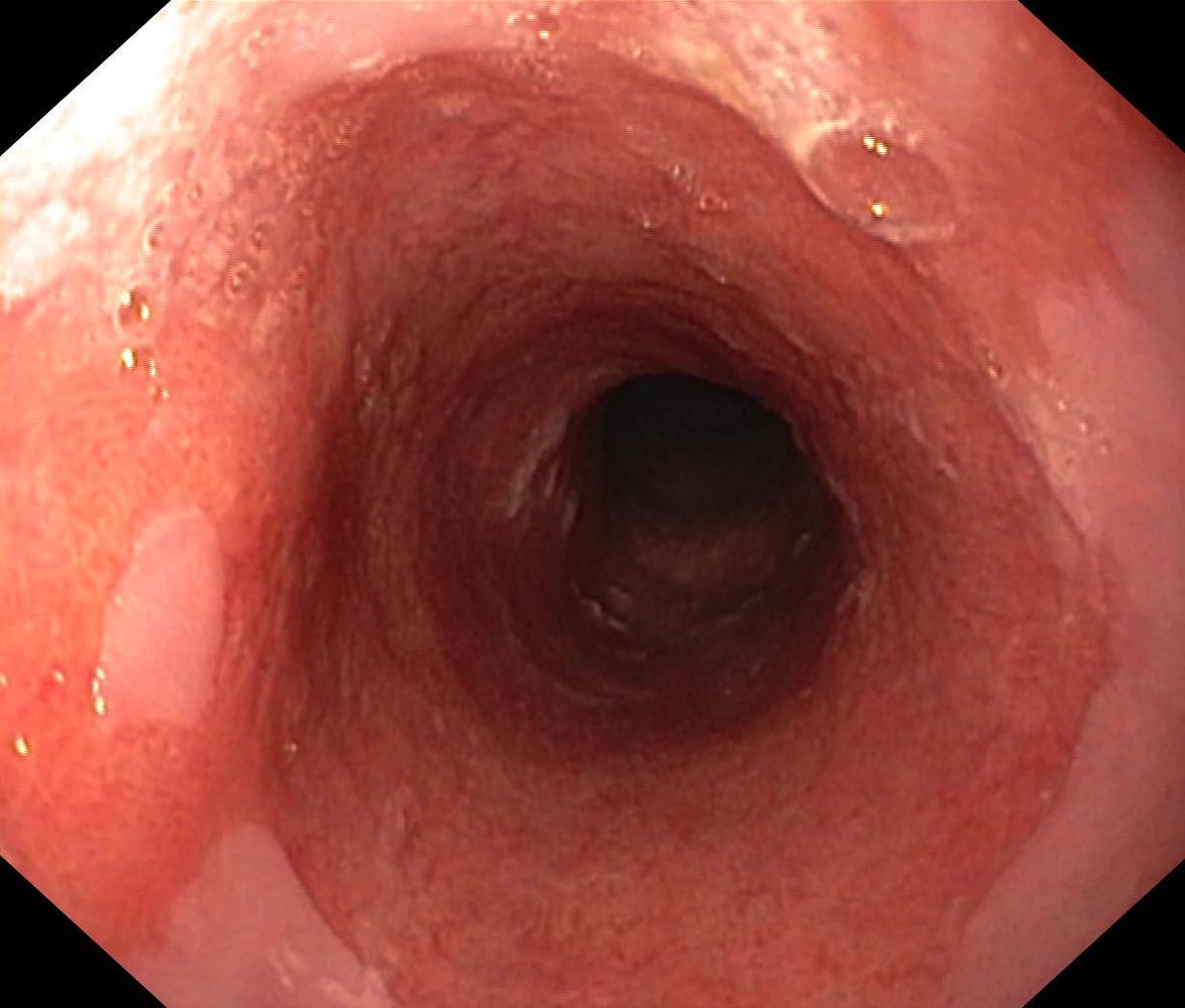 Long-segment Barrett esophagus