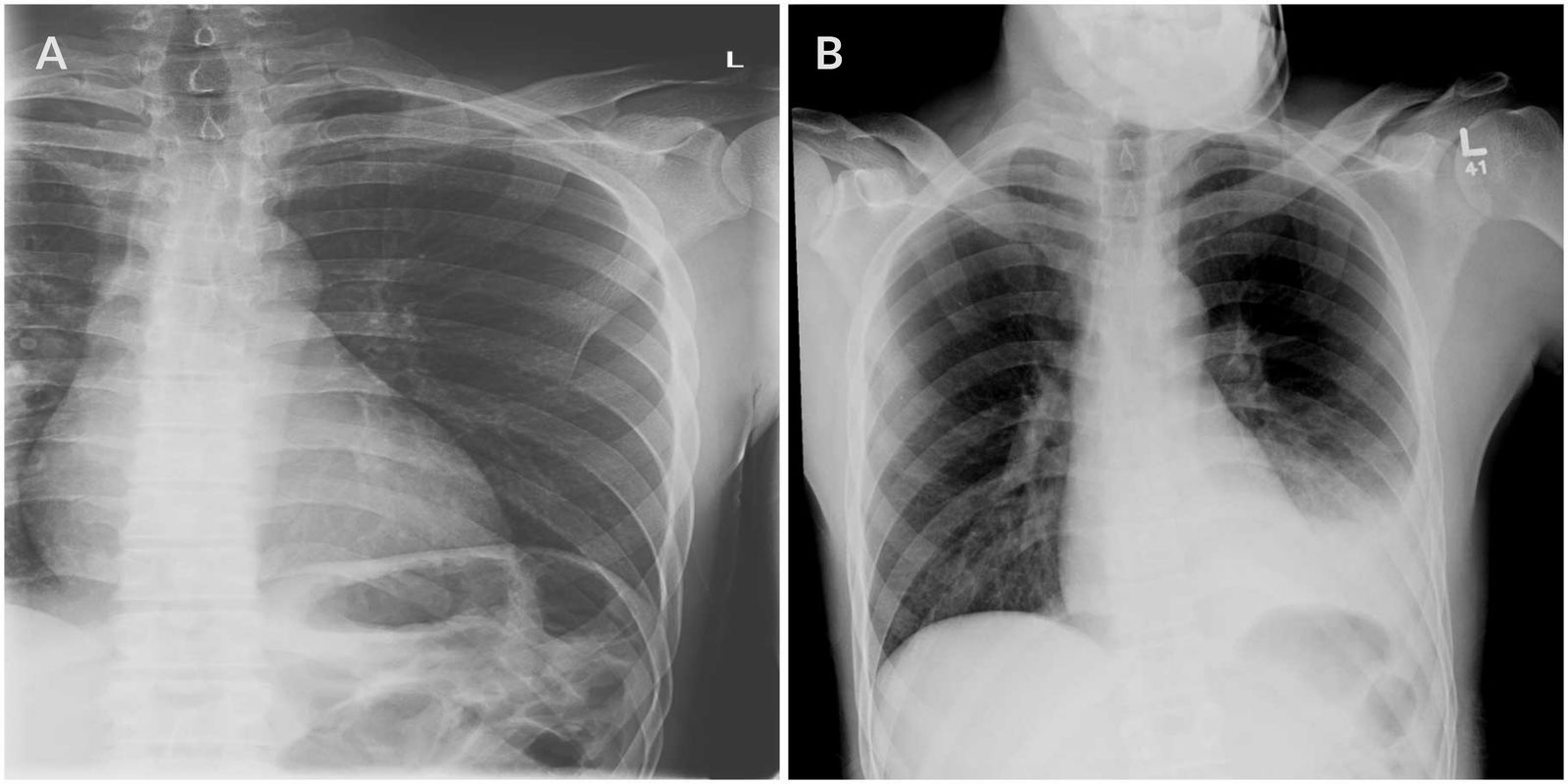 Hemothorax following rib fracture