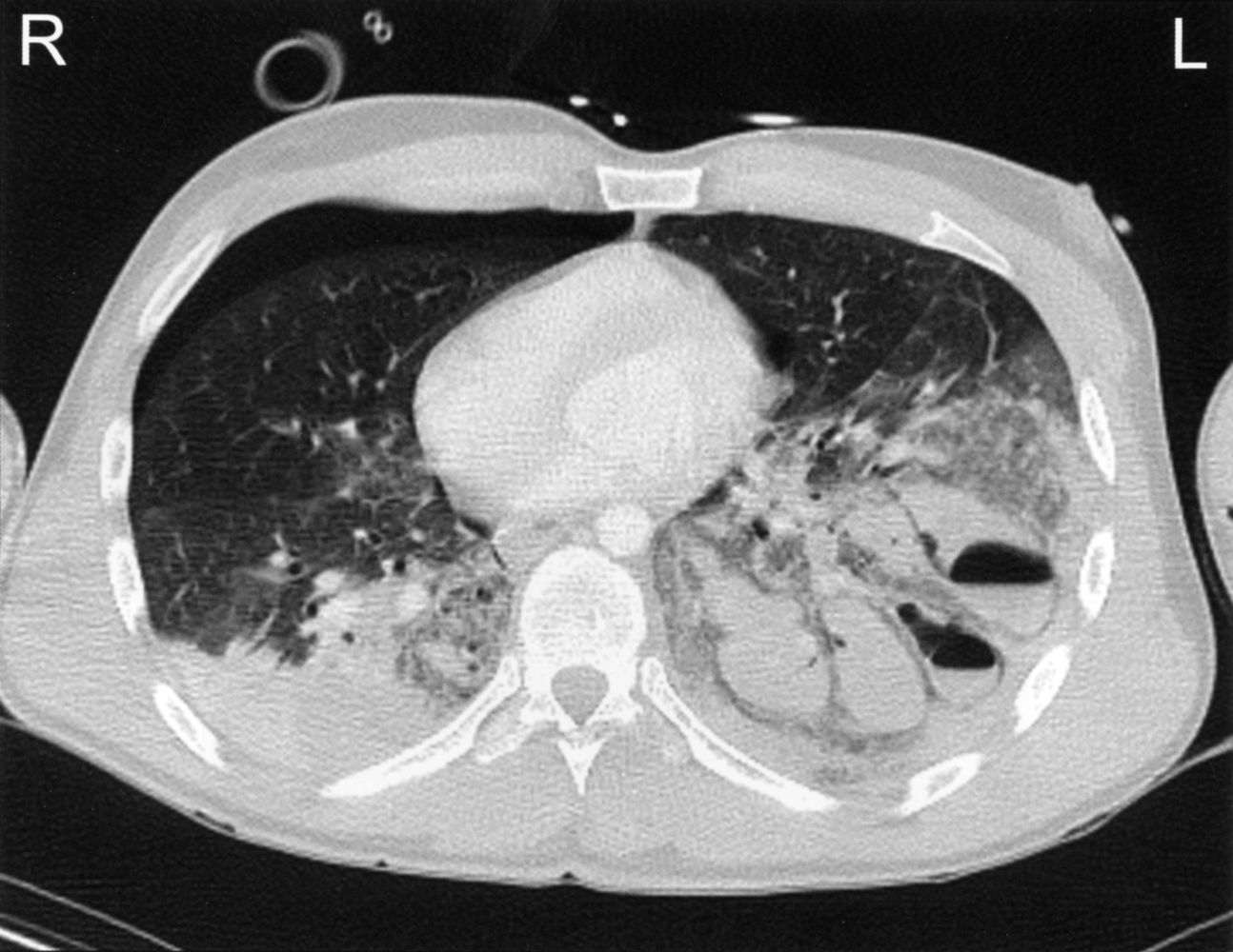 Pulmonary trauma